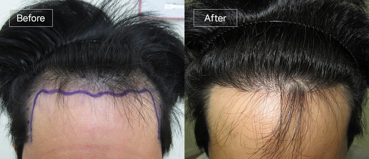 /filedata/md_board/20260102174401_1qNOvTFX_sub1_slide2.jpg 전후사진