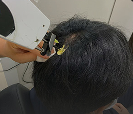 연세모벨르의원 탈모치료